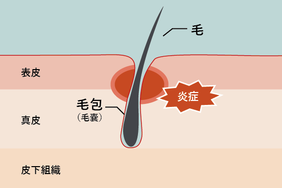 ⽑包炎（⽑嚢炎）